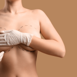 Breast Augmentation