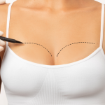 Breast Lift