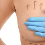 Breast Lift Augmentation