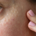 Dermapен® Microneedling