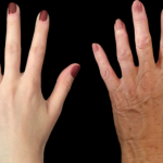 Hand Rejuvenation (Laser)