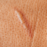 LED Therapy – Face