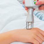 Laser Atrophic Scars