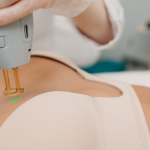 Laser Pigmented Scar