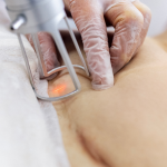 Laser Scar Treatment