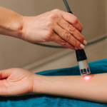 Laser Scar Treatment