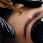 Laser Tattoo Removal