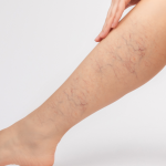 Leg Veins (Laser)