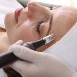 Morpheus8 RF Microneedling