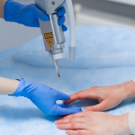 Nail Fungus Treatment (Laser)