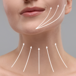 Neck Lift