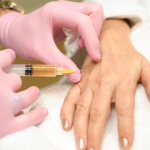 PRP Hand Rejuvenation