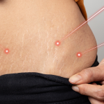 Profhilo® Bioremodeling