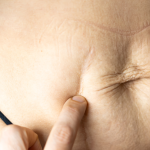 Laser Atrophic Scars