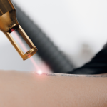 Tattoo Removal