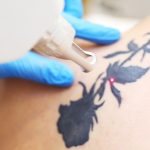Tattoo Removal