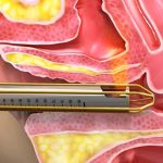 Vaginal Regeneration PRP + Exosomes