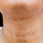 Warts Removal Surgery